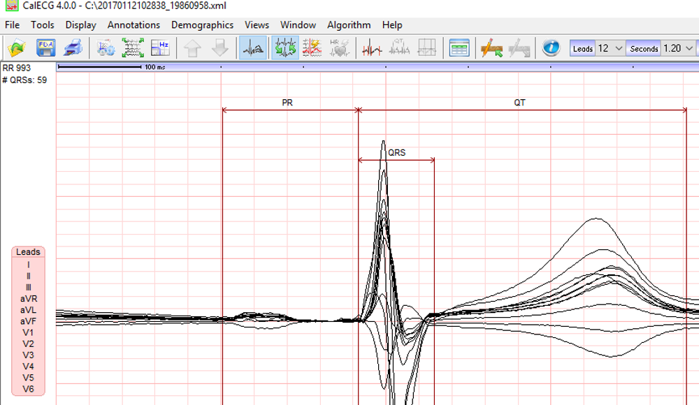 CalECG